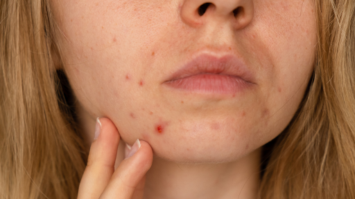 How microchanneling reduces acne scarring, stretch marks and more.