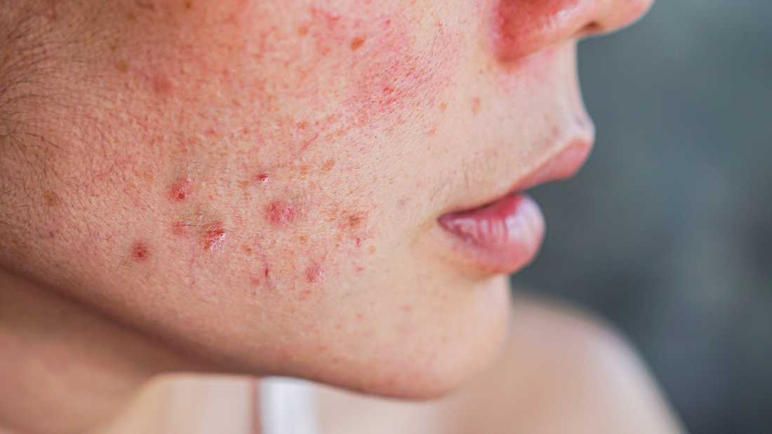 Out foul spot’: say goodbye to acne and scarring with dermaplaning
